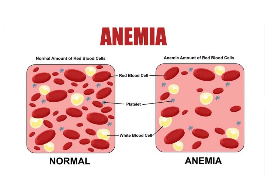 Because of the low iron levels, your bone marrow cant make as many blood cells. Your body also has a hard time making white blood cells making anemic people more susceptible to sickness. Infographic by: SelfDecode